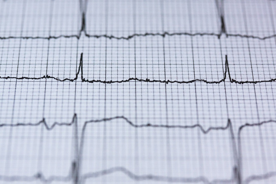 Exame ECG: qual a importância do Eletrocardiograma nas empresas?